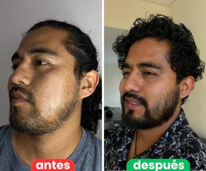 Bálsamo para Crecimiento de Barba Ultra Potente con Minoxidil 20% | 100mL